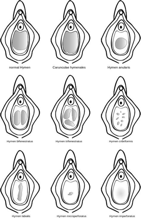 hymen pic|Types of Hymens